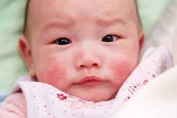 dị ứng thực phẩm