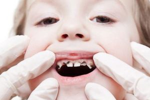 phòng ngừa sâu răng sớm cho trẻ