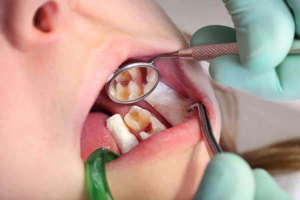 sâu răng sớm ở trẻ